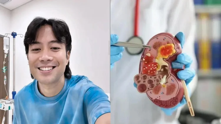 Kenali Kanker Ginjal, Penyakit yang Diderita Vidi Aldiano: Gejala, Faktor Risiko, dan Pencegahan